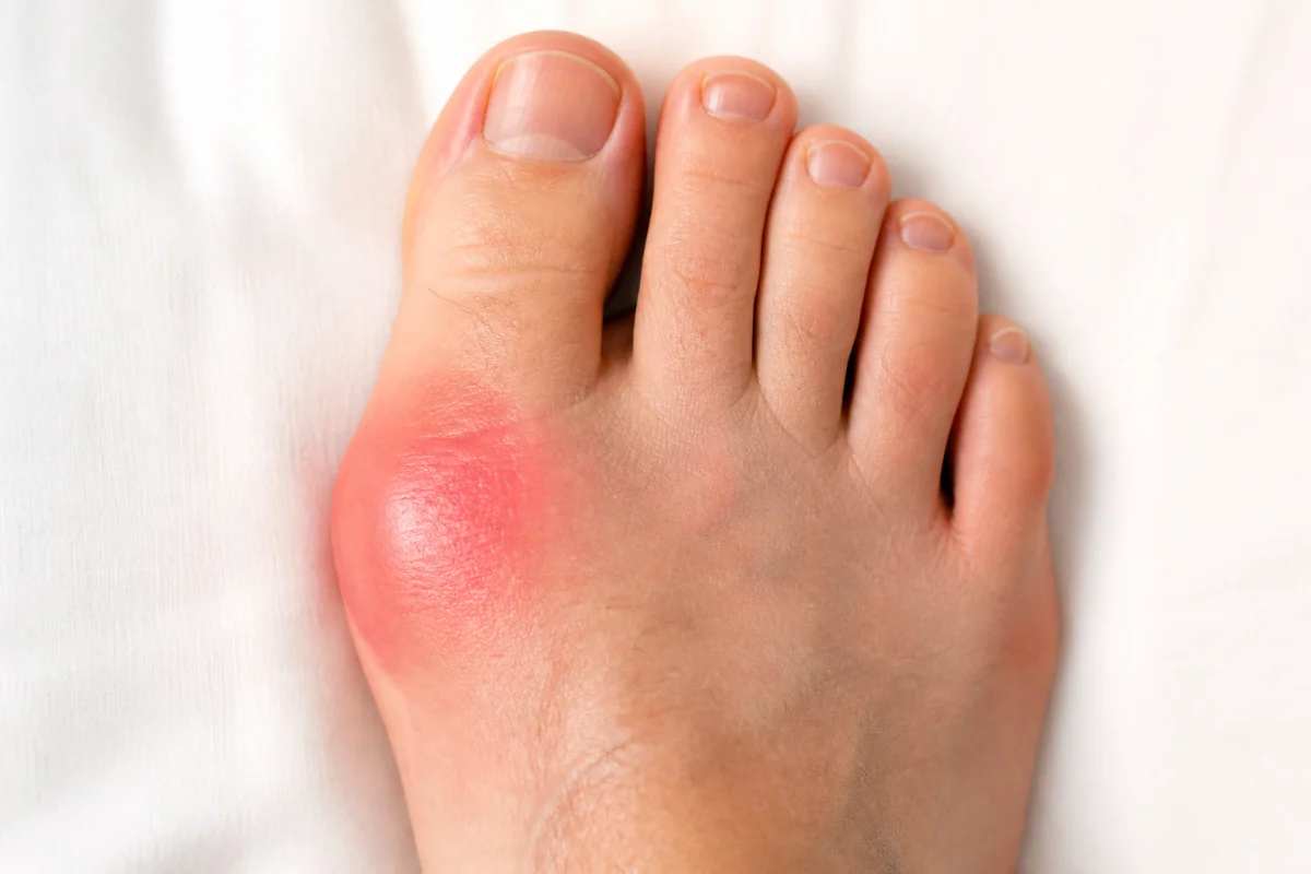 douleur pied goutte
