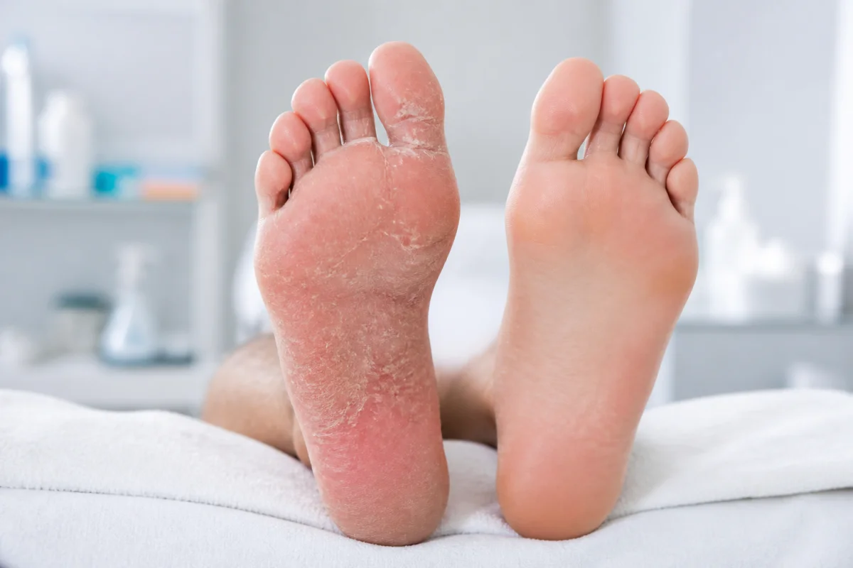Podologue et mycose du pied quand consulter et quels soins attendre