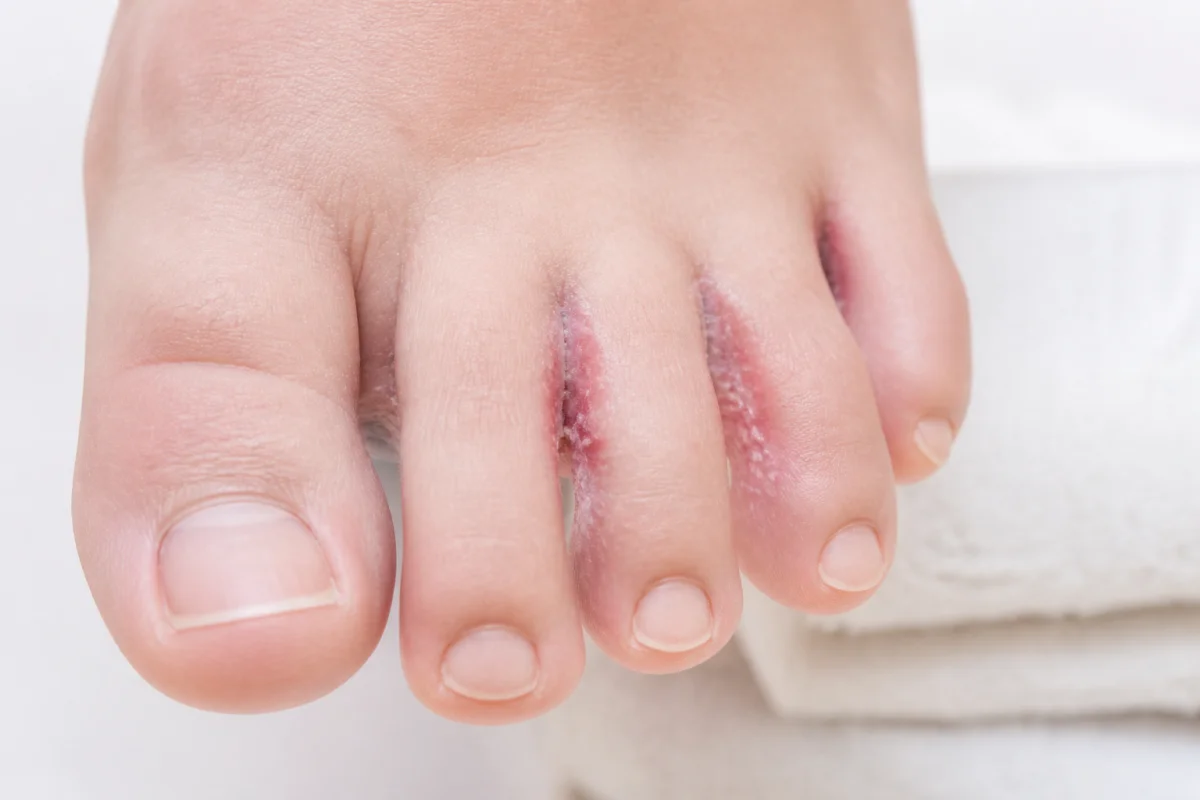 Diabète et mycose du pied comment réagir et prévenir les complications
