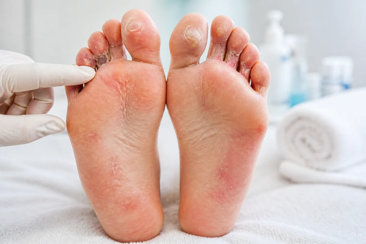 Diabète et mycose du pied comment réagir et prévenir les complications